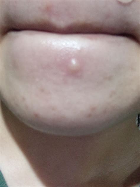 Under The Skin Pimples That Wont Pop