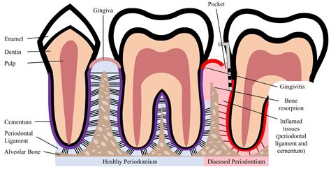Currently Available Treatments for Periodontal Disease | Encyclopedia MDPI