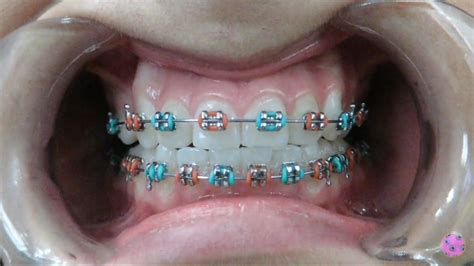 What Color Braces Look The Best at Dolores Futrell blog