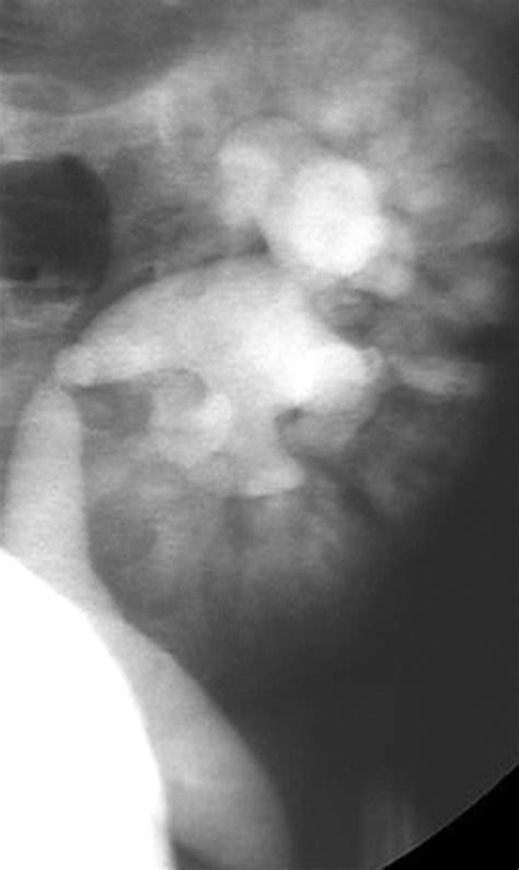 Vesicoureteral Reflux and Urinary Tract Infection: Evolving Practices and Current Controversies ...