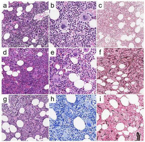 The Classification of Myeloproliferative Neoplasms: Rationale ...