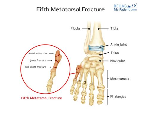 Fifth Metatarsal Fracture Treatment And Tips / Metatarsal Fractures ...