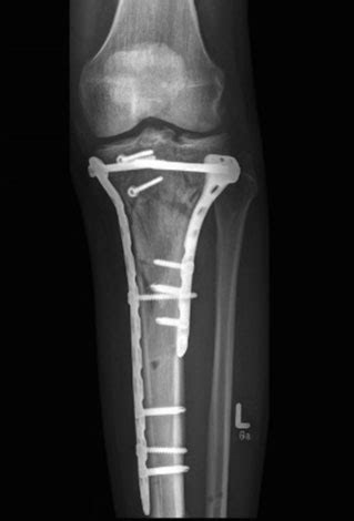 Fracture Trauma Surgery in Kharghar | Dr Sarang Patki