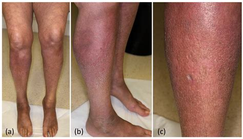 Hyperpigmented Scleroderma-like Lesions under Combined Pembrolizumab ...
