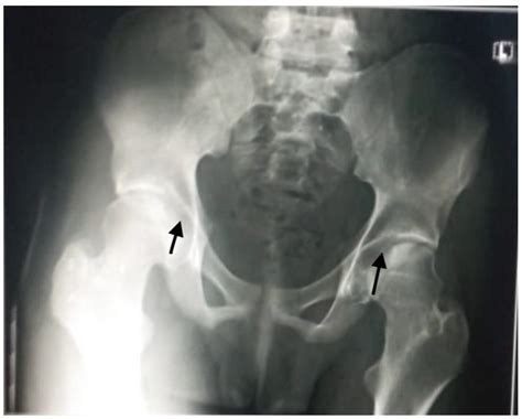 Management of Salter–Harris Type 1 Fracture Complicated with Osteomyelitis in a Sickle Cell ...