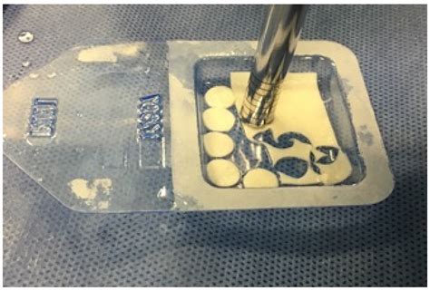 Autologous Matrix-Induced Chondrogenesis (AMIC) for Focal Chondral ...