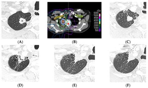Spectrum of Imaging Patterns of Lung Cancer following Radiation Therapy
