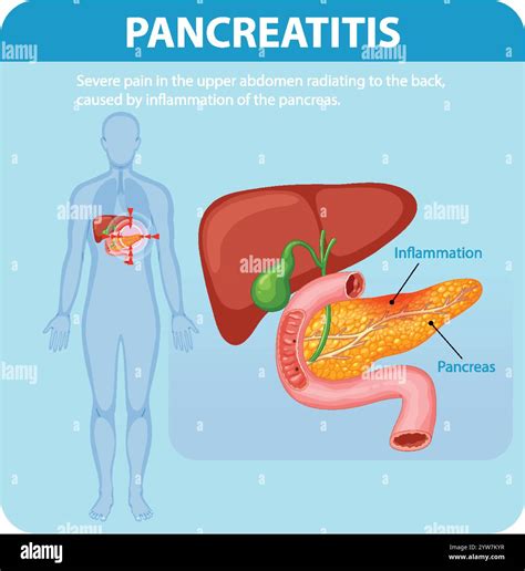 Radiating pain Stock Vector Images - Alamy