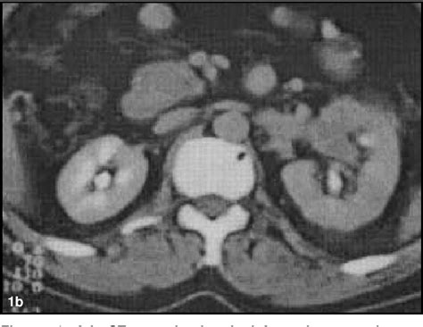 Image result for Hand-Assisted Radical Nephrectomy