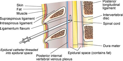 Thoracic Epidural Placement