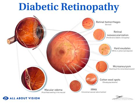 Diabetic Retinopathy Stages Sulodexide – A New Model For Treating
