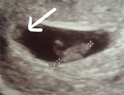 7 Week Ultrasound Identical Twins