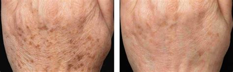 Daily Repair Body Oil for Psoriasis Scars and Marks (100 ml) – Oleum ...