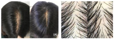 Dermatopathology | Special Issue : Dermatopathology and COVID-19