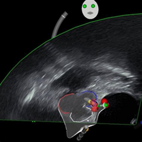 Image result for PVC Localization Chart
