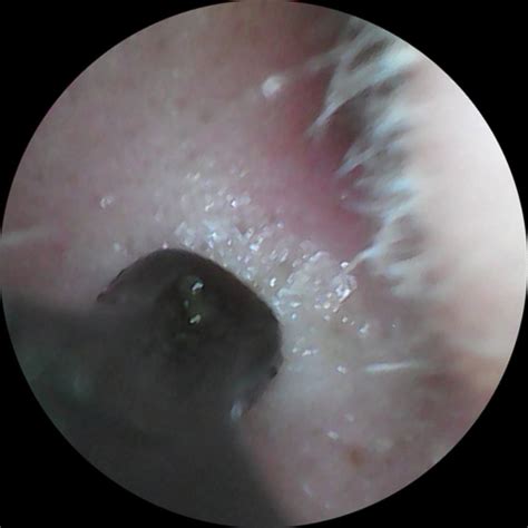 Image result for Loud Exploding Zit