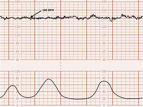 10.5 Fetal Heart Rate Monitoring - Nursing Health Promotion