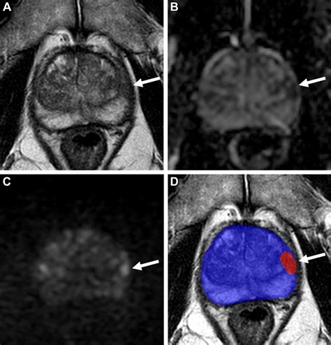 PI-RADS: Where Next? | Radiology