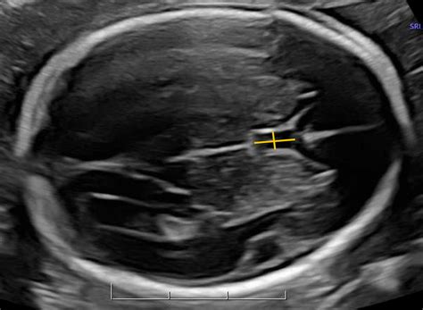 Cavum Septum Pellucidum Fetal Ultrasound