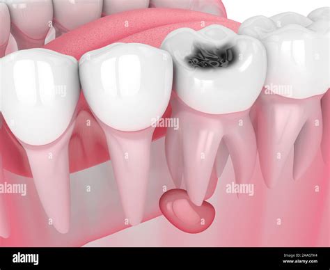 Wisdom Tooth Cyst Removal 的图像结果