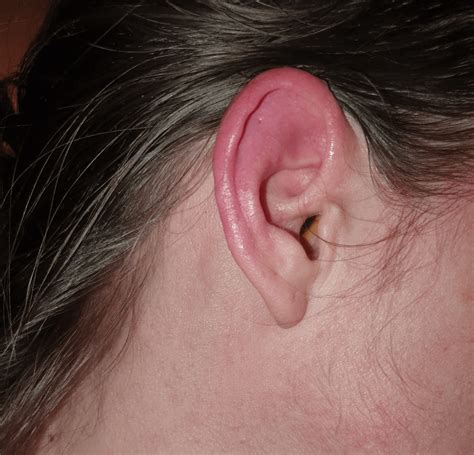 Red hot burning ears a symptom? Recently developed dermatographia but ...