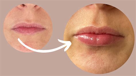 Natural Looking Lip Fillers for Thin Lips - Dr Liesel Holler