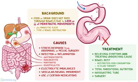 Mechanical Ileus Treatment at Tommy Lotts blog