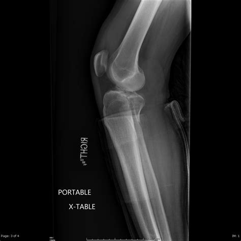 Posterior Tibial Plateau Fracture Treatment at Lidia Bechtol blog