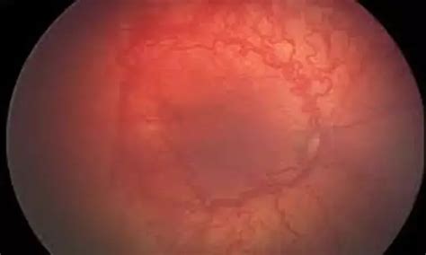 Very low-dose Avastin may help prevent retinopathy of prematurity:JAMA