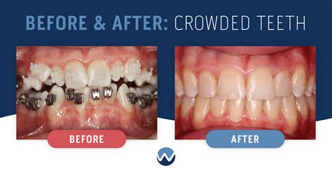 Crowded Teeth Treatment at Toni Esser blog