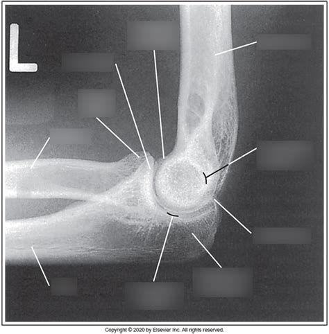 Image result for Elbow Contralateral