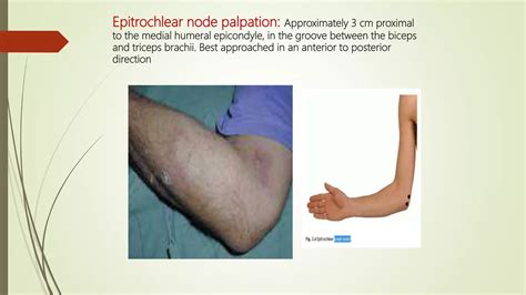 Lymphadenopathy | PPTX