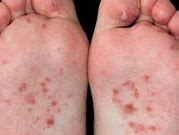 Image result for Rash On Foot and Ankle