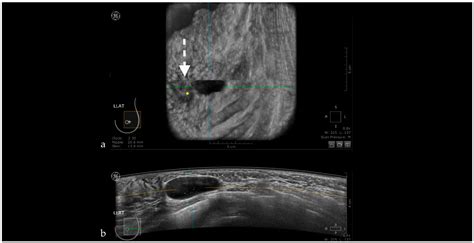 Pros and Cons for Automated Breast Ultrasound (ABUS): A Narrative Review