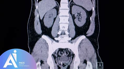 Abdominal and pelvic CT scan reading | AI-PACS