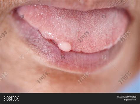 Cysts Tongue Mouth Image & Photo (Free Trial) | Bigstock
