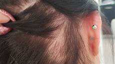 How To Style Hair With Traction Alopecia by Traction Alopecia How To Prevent And Fix It How To Style Hair With Traction Alopecia