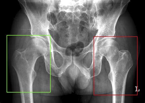 Hip Fracture X Ray