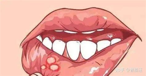 口腔溃疡和嘴唇疱疹 - 知乎