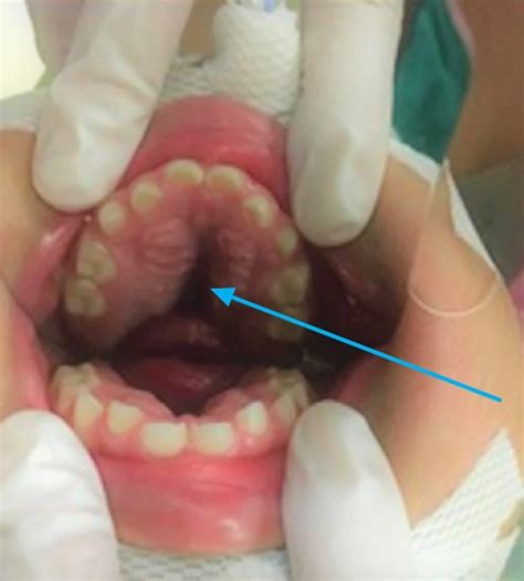 High arched palate causes, symptoms, diagnosis & treatment