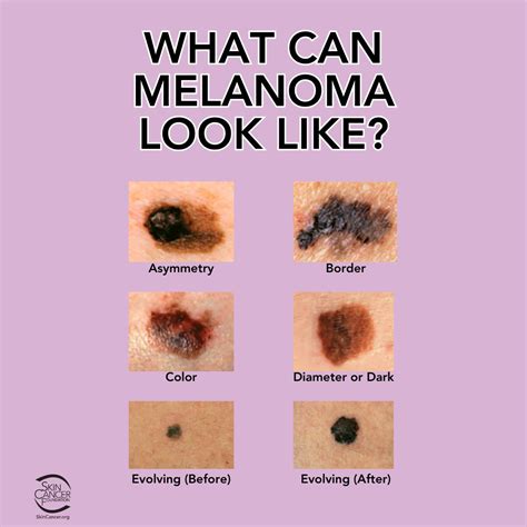 Melanoma Skin Cancer Stages