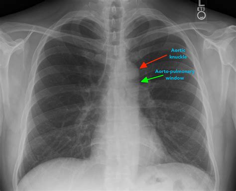 Chest X-ray Interpretation | A Structured Approach | Radiology | OSCE