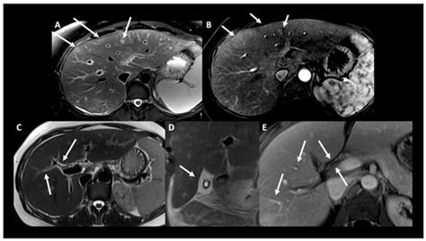 Eosinophilic Granulomatosis with Polyangiitis after mRNA-1273 SARS-CoV ...