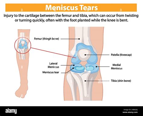 Illustration of knee meniscus tear and anatomy Stock Vector Image & Art - Alamy