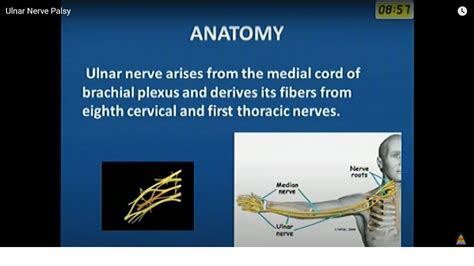 Ulnar Nerve Palsy Symptoms , Ulnar Nerve Entrapment: Causes, Symptoms & Treatment – QYUIST