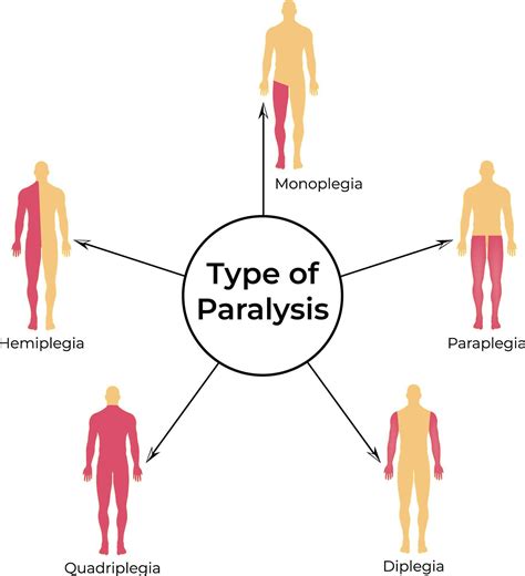 Types of Paralysis Hemiplegia Monoplegia Quadriplegia Paraplegia and ...