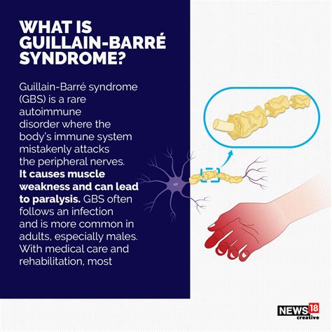 Guillain-Barré Syndrome Medcomic, 41% OFF