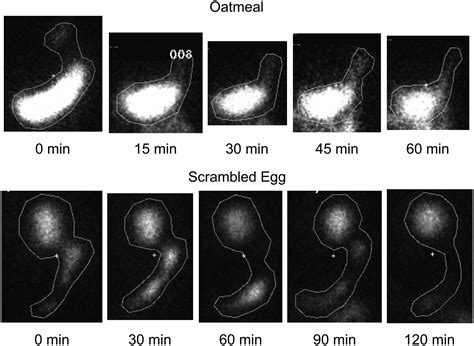 The Gastric Emptying Study: Protocol Design Considerations | Journal of Nuclear Medicine Technology