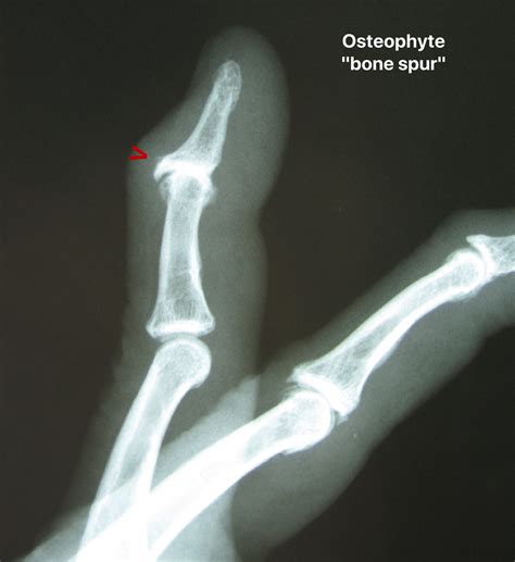 Hand Xray Bones