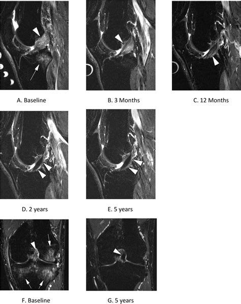 Evidence of ACL healing on MRI following ACL rupture treated with ...